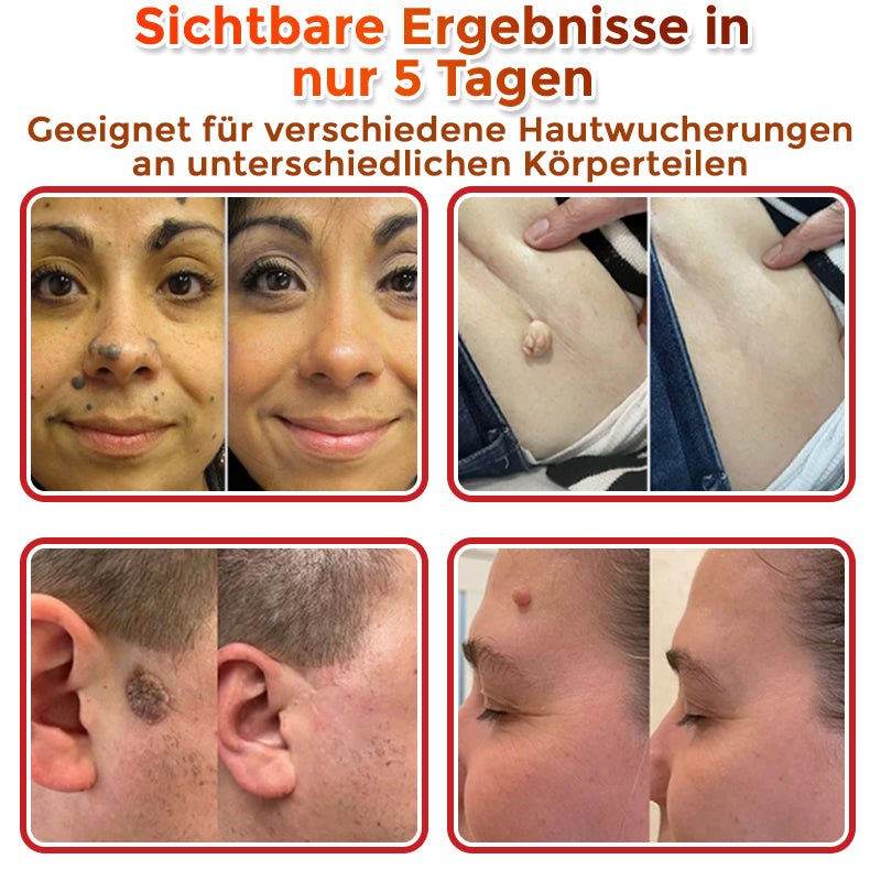 🇩🇪🌈GFOUK® Mikronadeln Botanisch Hautanhängsel Entfernung Patch