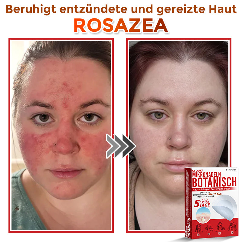 🇩🇪🌈GFOUK® Mikronadeln Botanisch Hautanhängsel Entfernung Patch