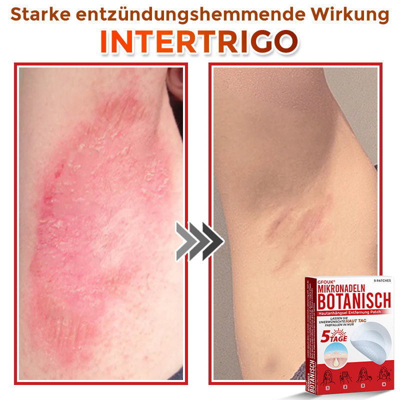 🇩🇪🌈GFOUK® Mikronadeln Botanisch Hautanhängsel Entfernung Patch