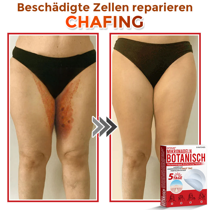 🇩🇪🌈GFOUK® Mikronadeln Botanisch Hautanhängsel Entfernung Patch