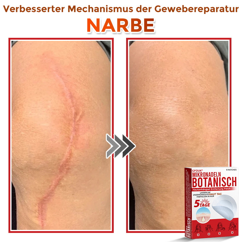 🇩🇪🌈GFOUK® Mikronadeln Botanisch Hautanhängsel Entfernung Patch