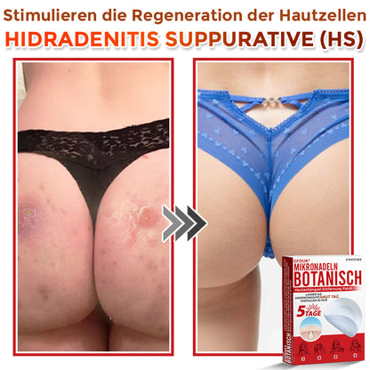🇩🇪🌈GFOUK® Mikronadeln Botanisch Hautanhängsel Entfernung Patch